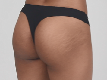 butt gluteal augmentation with silicon implants