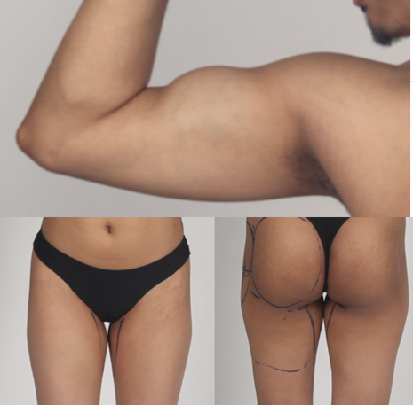 thigh arm bicep lift contouring toning