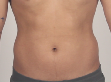 Tummy tuck Six pack high definition abs 3d