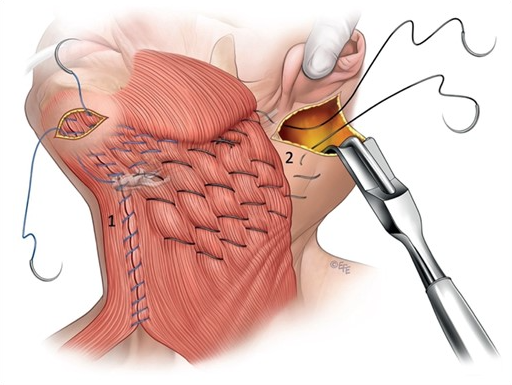 Neck lift and neck contouring incisions