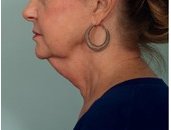 Neck lift neck contouring pre op 2