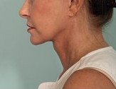 neck lift neck contouring post op 2