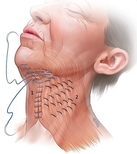 neck lift and neck contouring